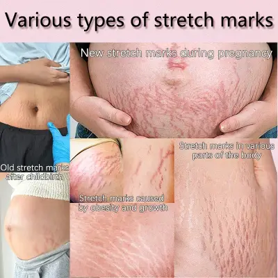 Anti-Stretch Mark Cream